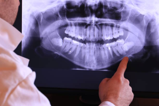 Best Emergency Wisdom Teeth Removal in Steubenville, OH